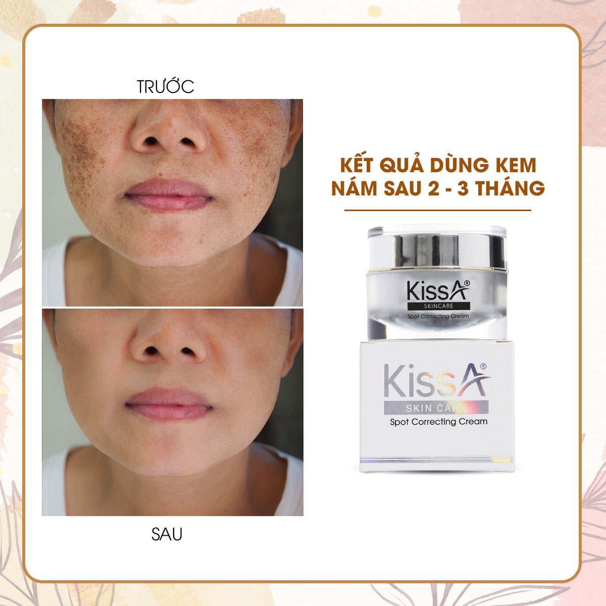 kem-tri-nam-da-kissa